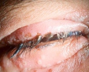 Illustration for article titled Tips Cara Pengobatan Penyakit Herpes